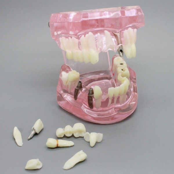 歯科透明インプラント解析/水平埋伏智歯/齲蝕/歯周病模型