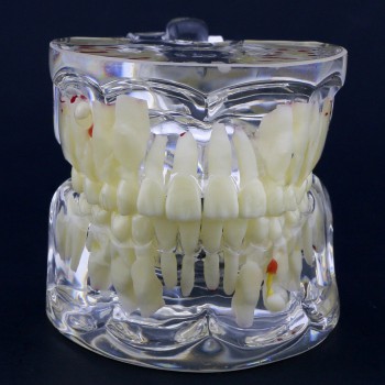 透明乳歯疾患模型 子供小児歯科病理模型 #4002