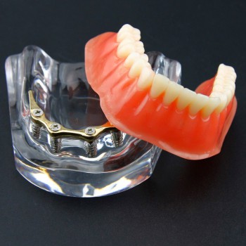 歯科インプラント用モデル 下顎精密インプラント模型
