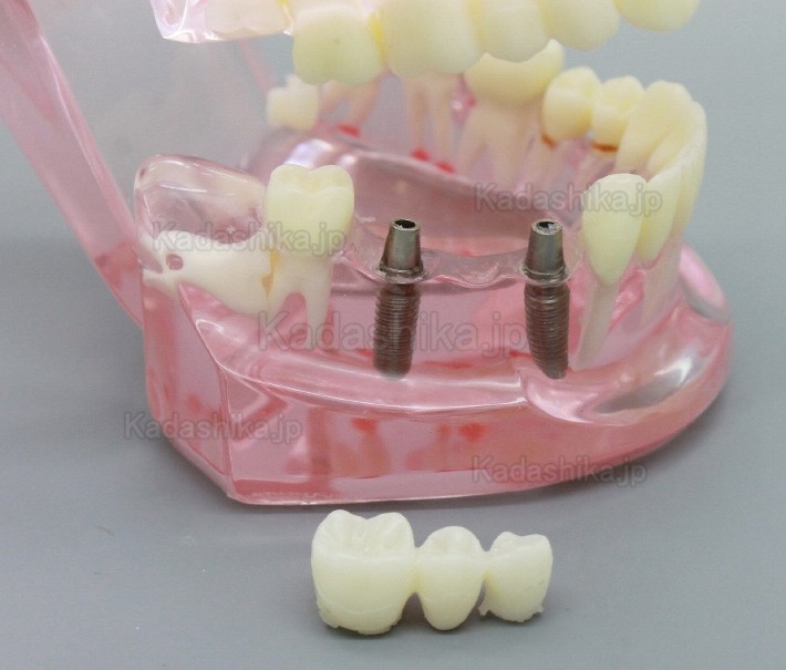 歯科透明インプラント解析/水平埋伏智歯/齲蝕/歯周病模型