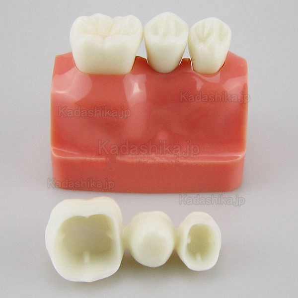 JX®M2017 歯科インプラント・クラウン歯模型
