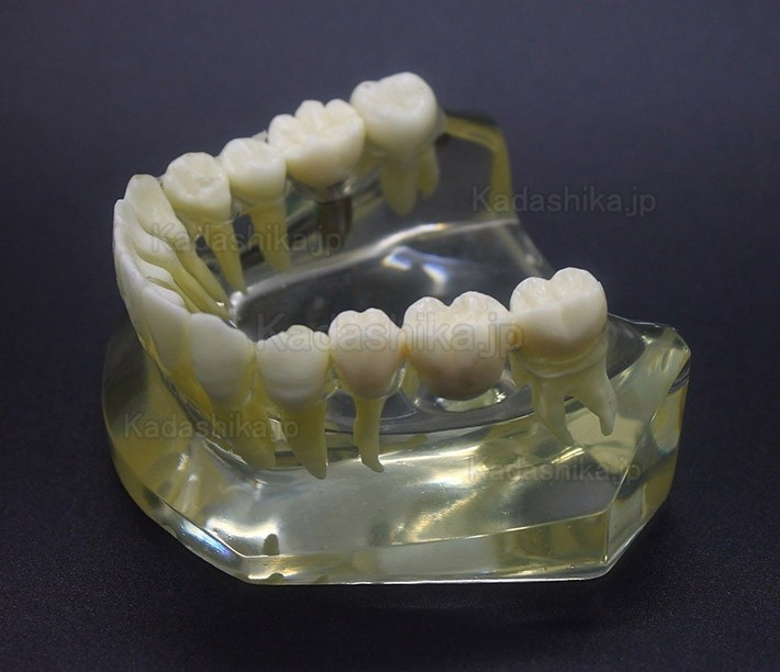 歯科インプラント説明用模型 (インプラントとブリッジの違い説明)