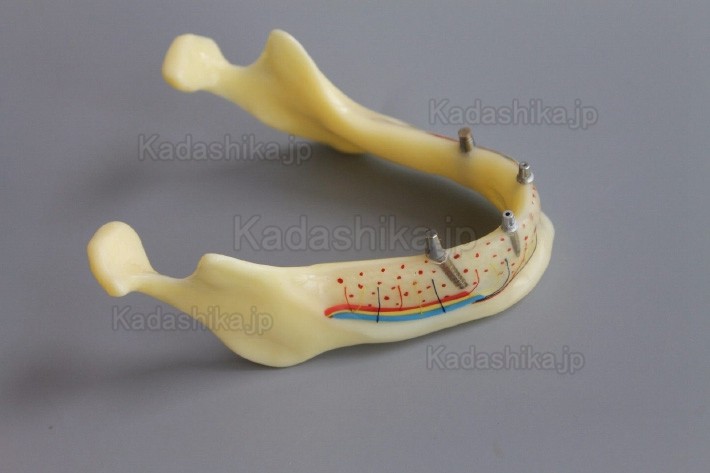 下顎骨組織とインプラント模型 + オーバーデンチャーモデル ＃2014 02