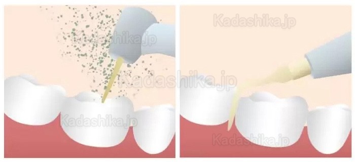 Refine MaxSurgery 歯科用超音波骨切削器 ピエゾボーン手術システム