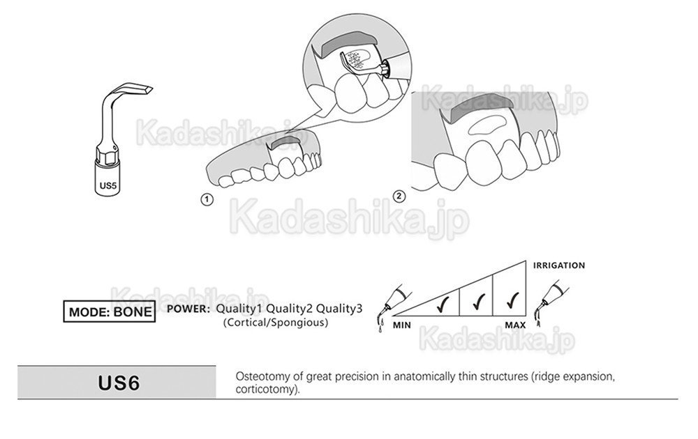 歯科ピエゾサージェリーチップ US1 US1L US1R US2 US3 US4 US5 US6 US7 US11 US12 (Mectron Woodpeckerに適用)